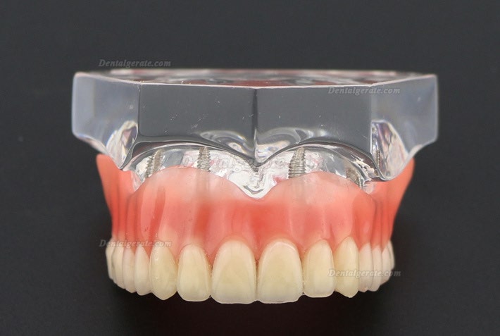 Anatomisches Modell der Zahnz&auml;hne &Uuml;berprothese Superior mit 4 Implantaten Demo Modell 6001